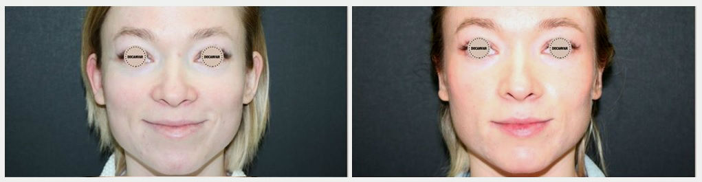 Фото до и после отопластики у пластического хирурга Салиджанова Анвара Шухратовича