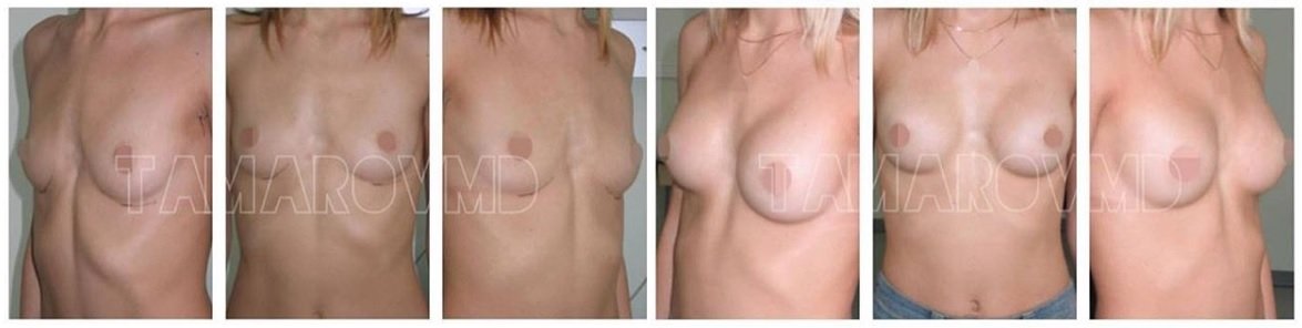 Фото до и после маммопластики у пластического хирурга Тамарова Алексея Николаевича