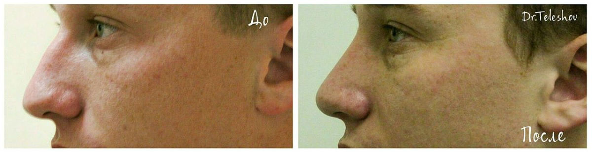 Фото до и после пластики носа у пластического хирурга Телешова Сергея Борисовича