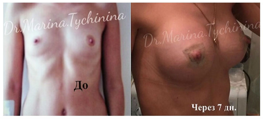Фото до и после пластики груди у пластического хирурга Тычининой Марины Николаевны