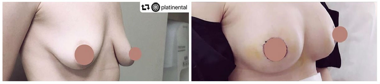 Фото до и после пластики груди у пластического хирурга Васильева Максима Николаевича