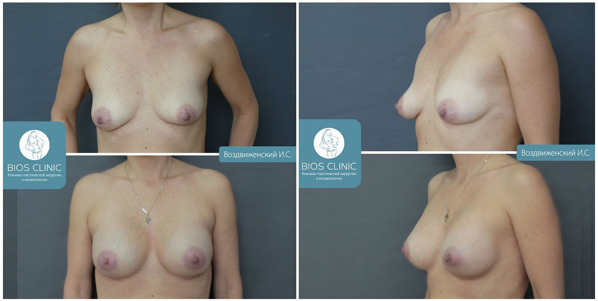 Фото до и после пластики груди у пластического хирурга Воздвиженского Ивана Сергеевича