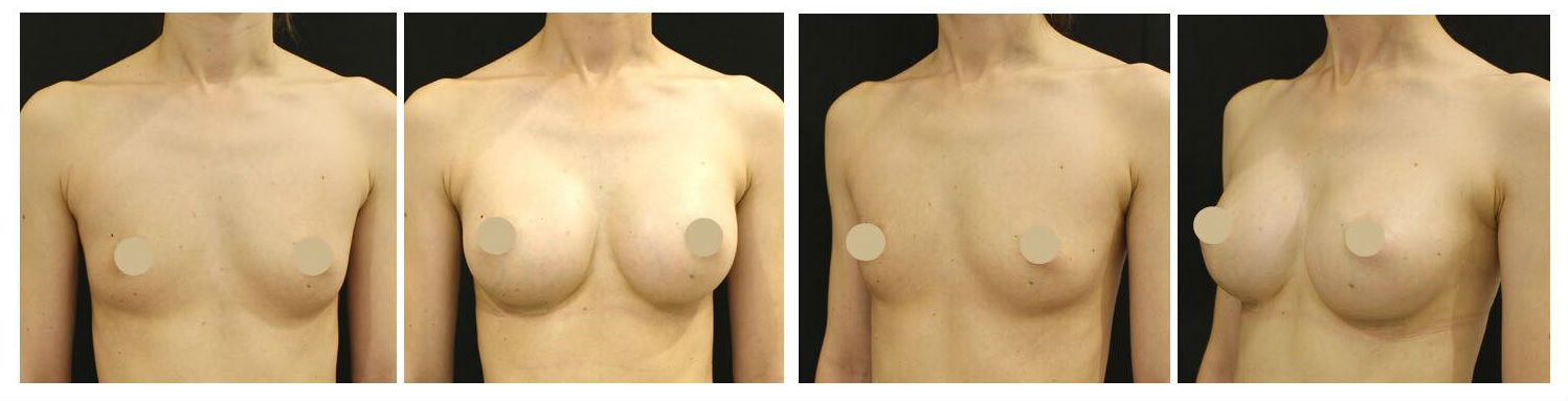 Фото до и после пластики груди у пластического хирурга Зленко Владимира Александровича