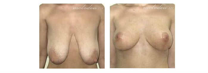 Фото до и после операции пластики груди у пластического хирурга Терезанова Олега Юрьевича