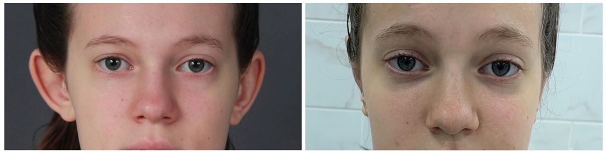 Фото до и после пластики ушей у пластического хирурга Выговского Андрея Павловича