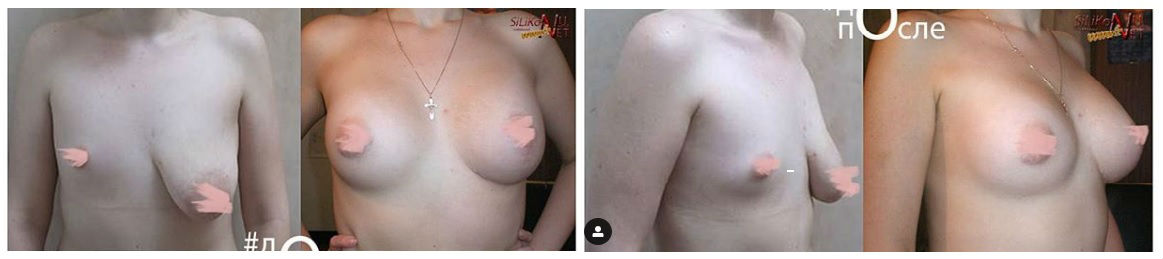 Фото до и после маммопластики у пластического хирурга Абакумова Александра Михайловича