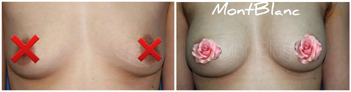 Фото до и после маммопластики у пластического хирурга Бакирханова Сарвара Казимовича