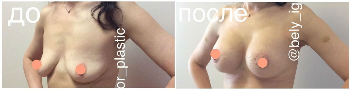 Фото до и после маммопластики у пластического хирурга Белого Игоря Анатольевича