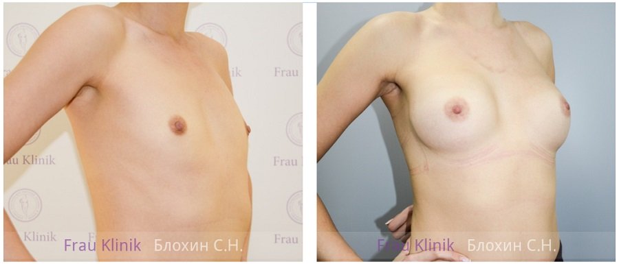 Фото до и после маммопластики у пластического хирурга Блохина Сергея Николаевича