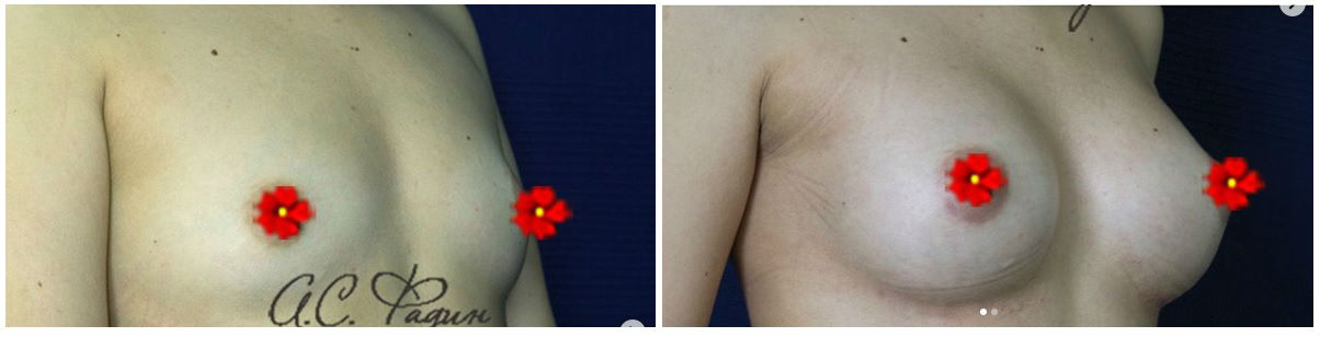 Фото до и после маммопластики у пластического хирурга Фадина Александра Сергеевича