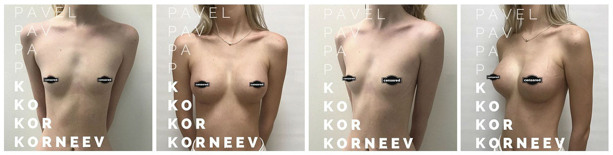 Фото до и после маммопластики у пластического хирурга Корнеева Павла Владимировича