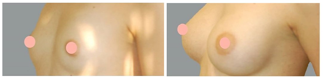 Фото до и после маммопластики у пластического хирурга Никитина Олега Леонидовича