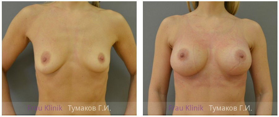 Фото до и после маммопластики у пластического хирурга Тумакова Глеба Игоревича