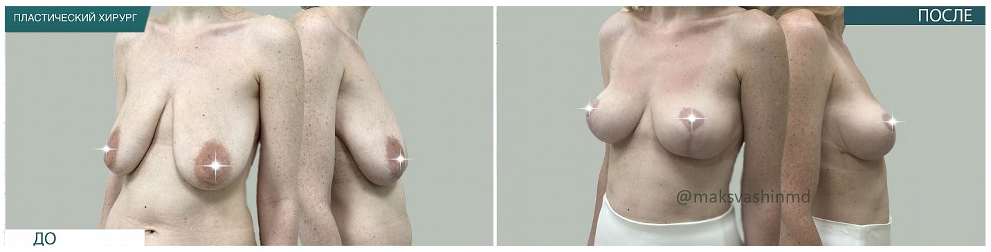 Фото до и после маммопластики у пластического хирурга Вашина Максима Петровича