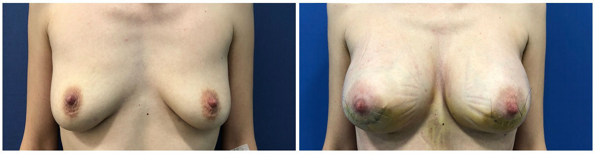 Фото до и после маммопластики у пластического хирурга Ведрова Олега Вячеславовича