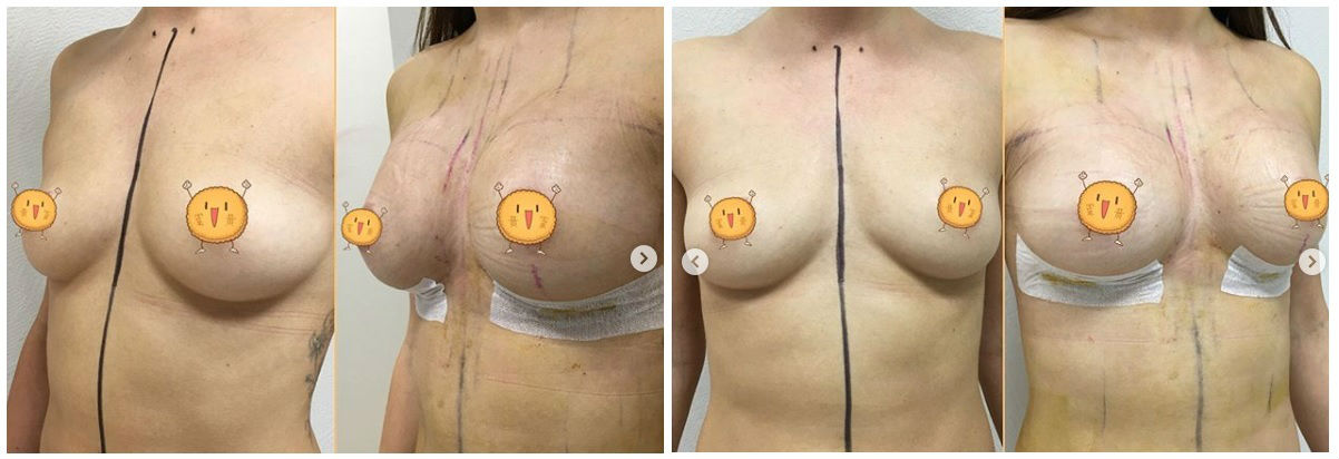 Фото до и после маммопластики у пластического хирурга Ворошкевича Павла Андреевича