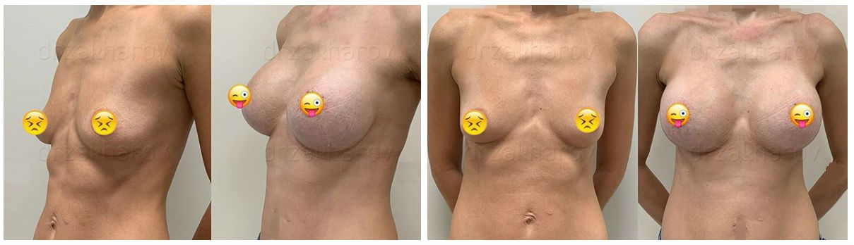 Фото до и после маммопластики у пластического хирурга Захарова Антона Игоревича