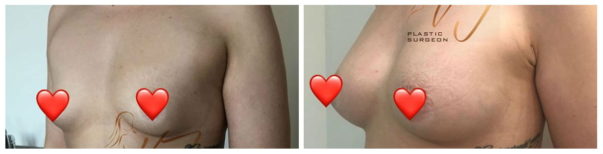 Фото до и после операции по увеличению груди у пластического хирурга Васильевой Юлии Сергеевны