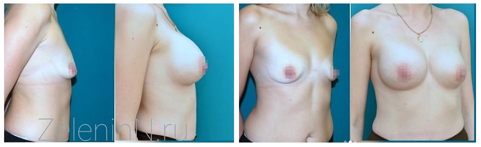 Фото до и после маммопластики у пластического хирурга Зеленина Николая Вадимовича