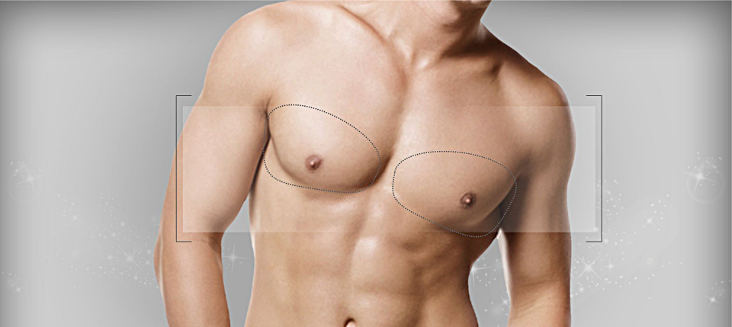 Импланты для операции увеличения груди у мужчин