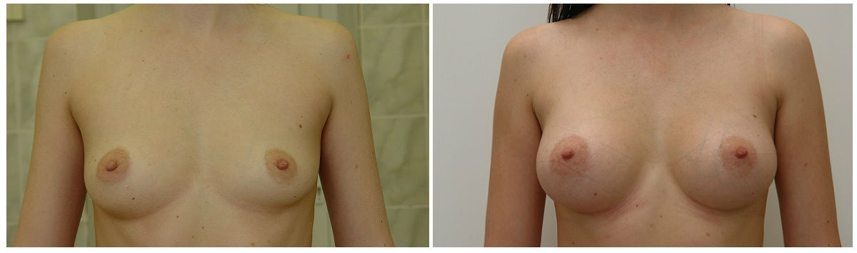 Фото до и после маммопластики у пластического хирурга Якимец Валерий Григорьевич