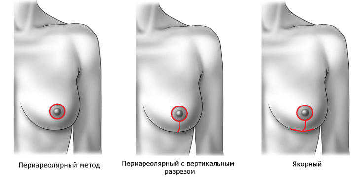 Подтяжка груди (мастопексия) в Москве