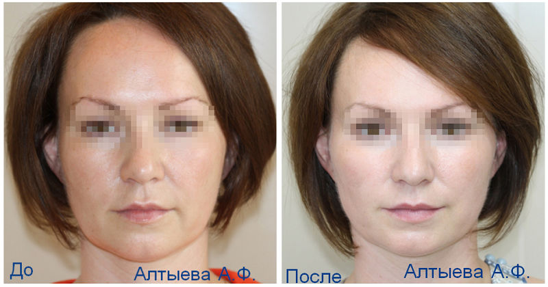 Фото до и после у пластического хирурга Алтыевой Аделины Фуатовны