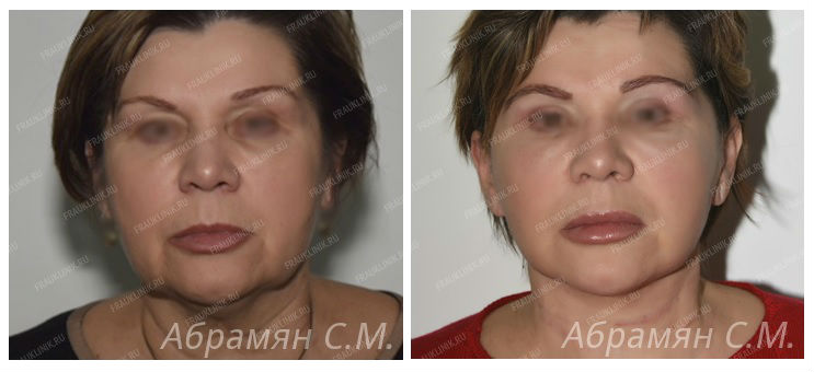 Фото до и после пластики лица у пластического хирурга Абрамяна Соломона Маисовича