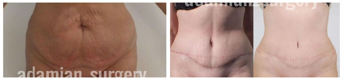 Фото до и после операции пластики губ у пластического хирурга Адамяна Рубена Татевосовича