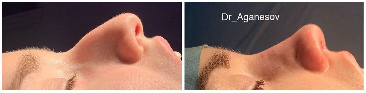 Фото до и после после пластики носа у пластического хирурга Аганесова Георгия Александровича