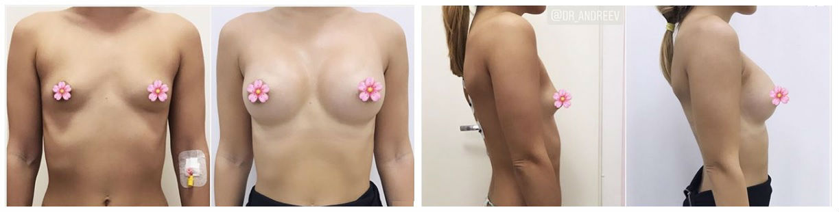 Фото до и после пластики груди у пластического хирурга Андреева Александра Сергеевича