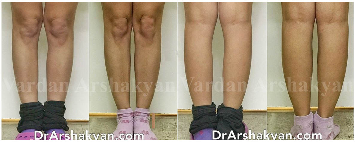 Фото до и после пластики голеней у пластического хирурга Аршакяна Вардана Арамаисовича