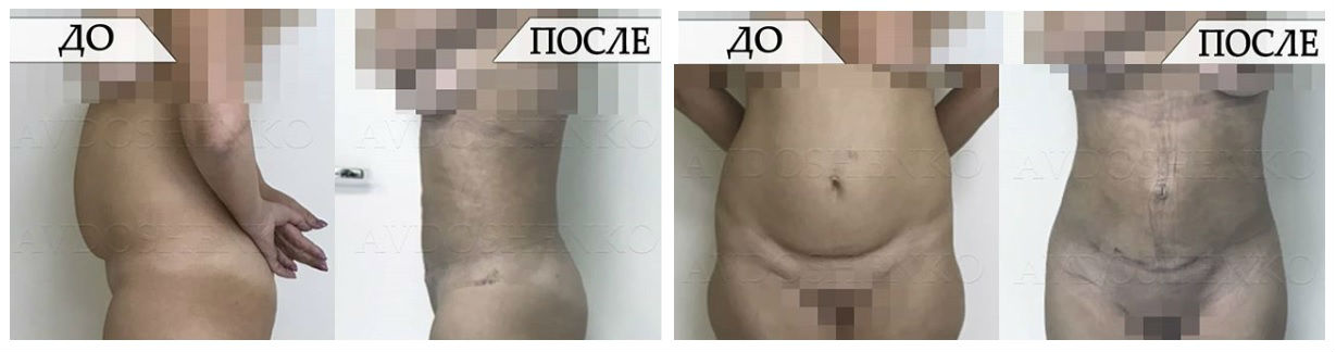 Фото до и после пластики живота у пластического хирурга Авдошенко Ксении Евгеньевны