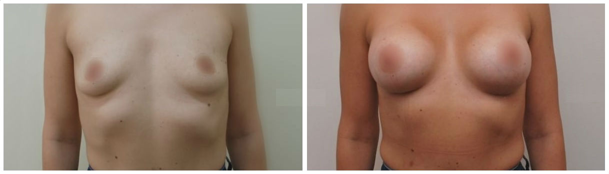 Фото до и после маммопластики у пластического хирурга Азизяна Ваагна Самвеловича
