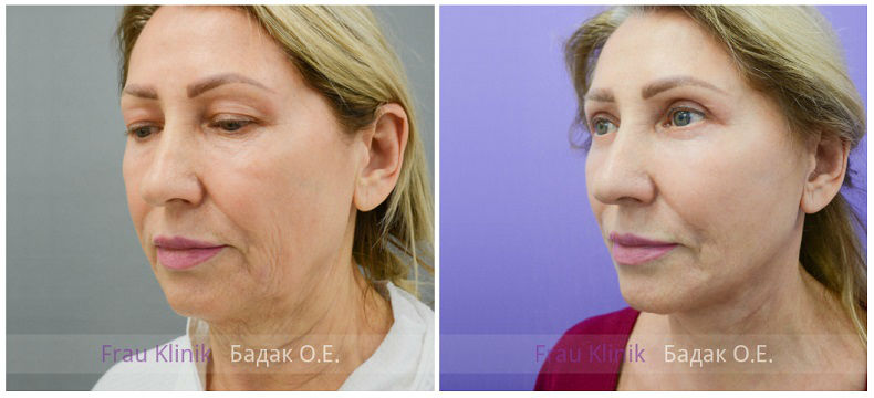 Фото до и после операции у пластического хирурга Бадак Олега Евгеньевича