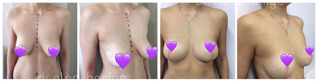 Фото до и после пластики груди у пластического хирурга Банижа Олега Николаевича