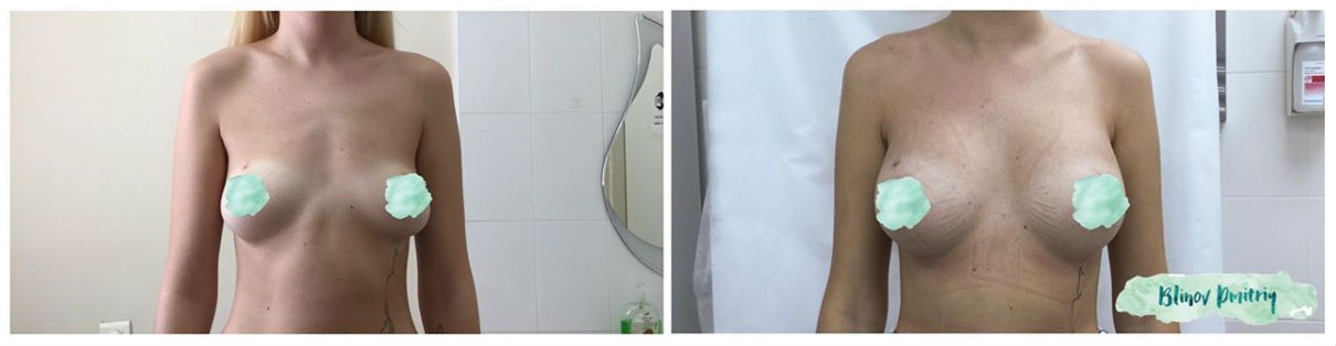 Фото до и после операции коррекции груди у пластического хирурга Блинова Дмитрия Александровича