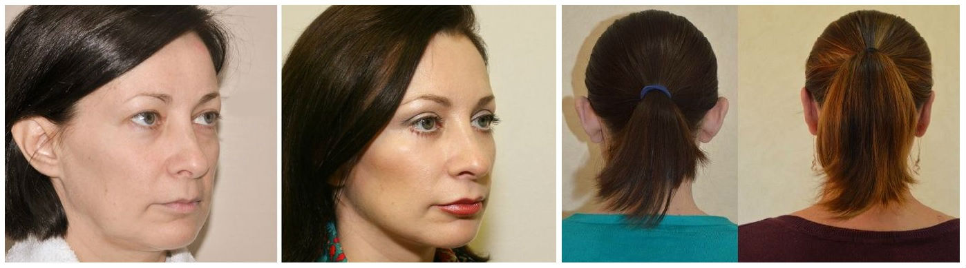 Фото до и после операции у пластического хирурга Бурого Анатолия Владимировича