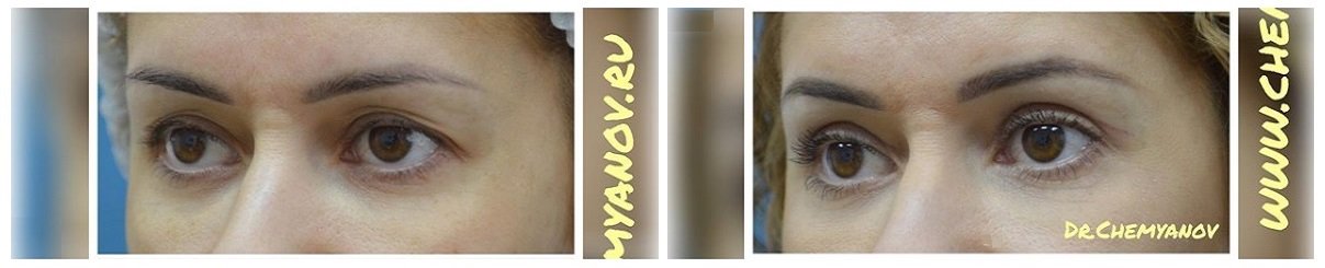 Фото до и после блефаропластики у пластического хирурга Чемянова Георгия Станиславовича