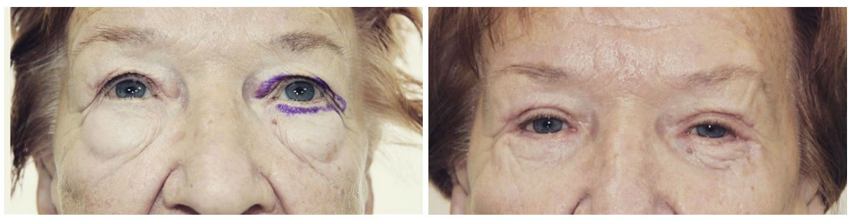 Фото до и после блефаропластики у пластического хирурга Дикарева Алексея Сергеевича