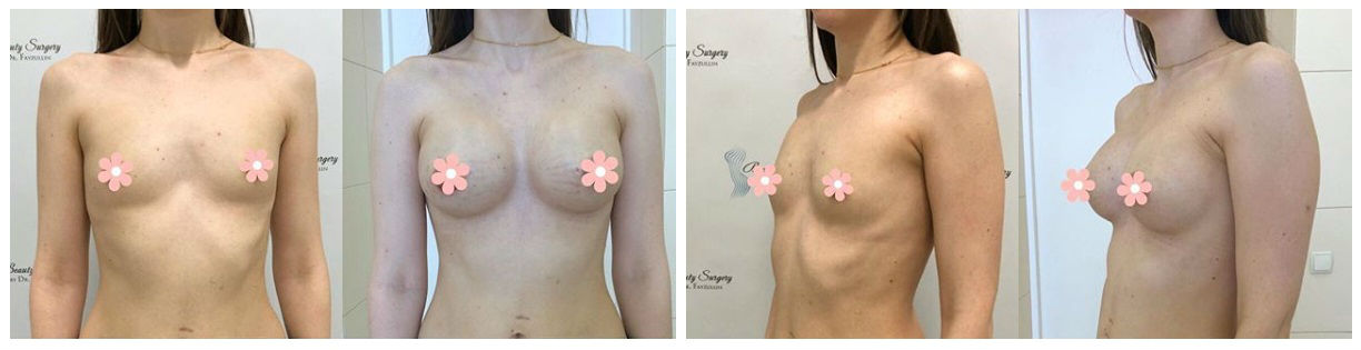 Фото до и после операции коррекции груди у пластического хирурга Файзуллина Тагира Ришатовича