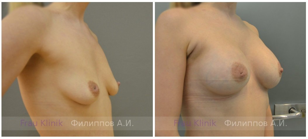 Фото до и после операции у пластического хирурга Филиппова Александра Игоревича