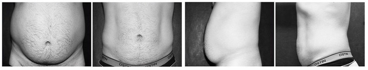 Фото до и после операции липофилинга груди у пластического хирурга Ганьшина Игоря Борисовича