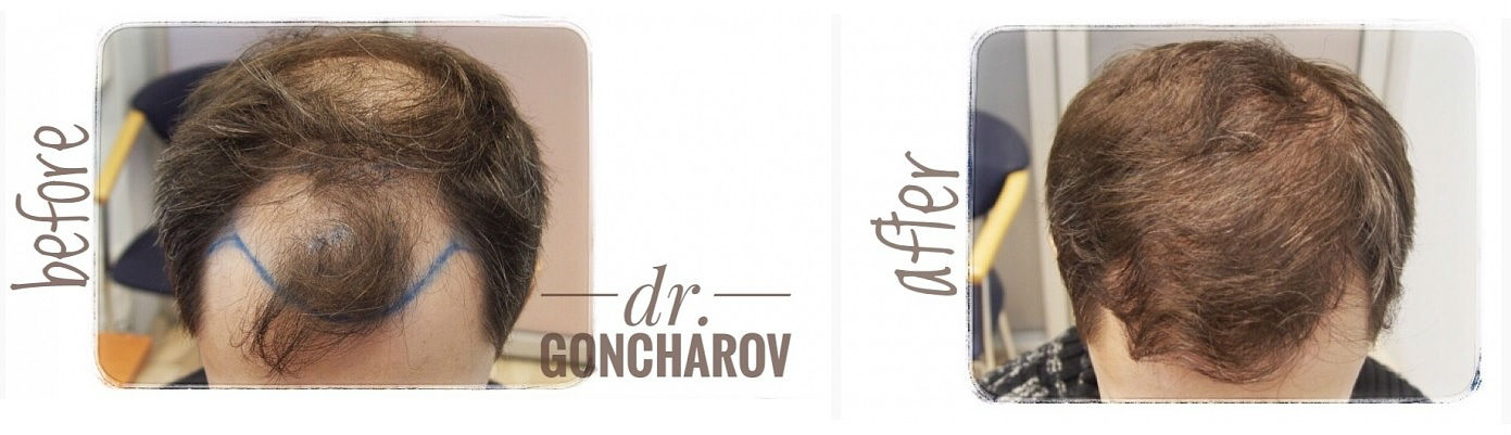 Фото до и после операции по пересадке волос у пластического хирурга Гончарова Александра Петровича