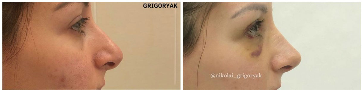 Фото до и после операции пластики носа у пластического хирурга Григоряка Николая Михайловича