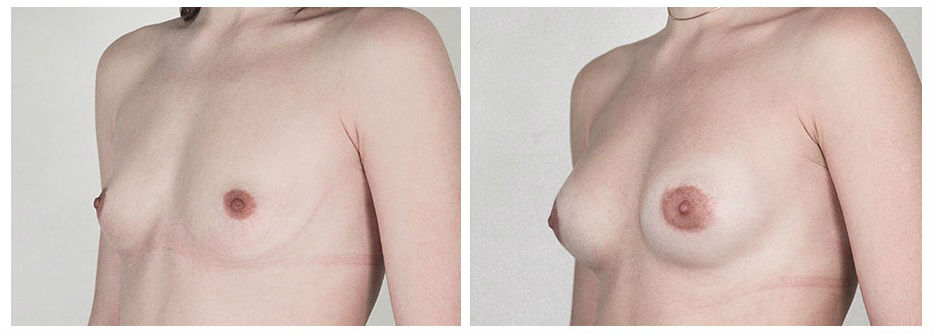 Фото до и после операции маммопластики у пластического хирурга Грищенко Светланы Владимировны