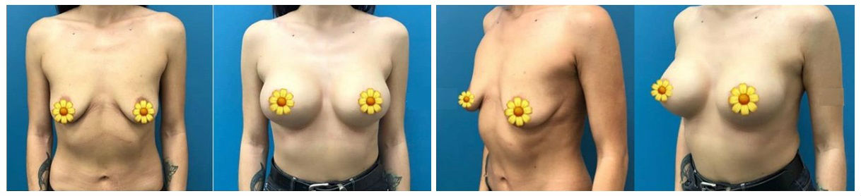 Фото до и после пластики груди у пластического хирурга Иоселиани Нодари Багратовича