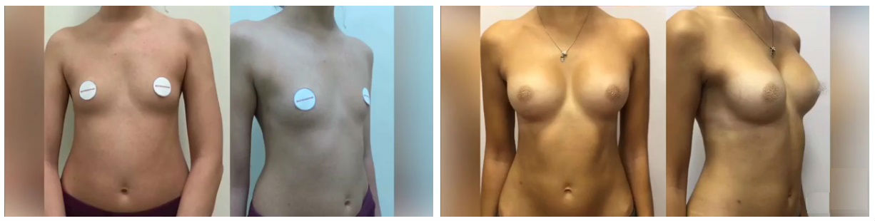Фото до и после маммопластики у пластического хирурга Качина Юрия Алексеевича