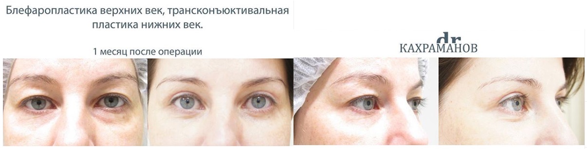 Фото до и после блефаропластики у пластического хирурга Кахраманова Эльдара Бегларовича