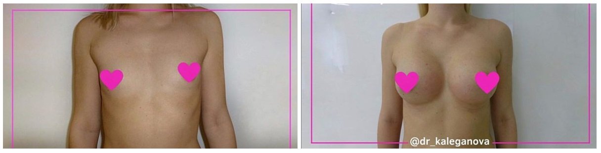 Фото до и после маммопластики у пластического хирурга Калегановой Анны Юрьевны